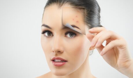 Cum poti preveni acneea hormonala